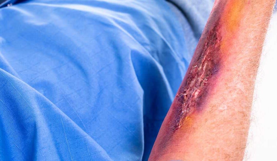 Indianapolis Burn Injury Lawyers Discuss Chemical Burn Risks