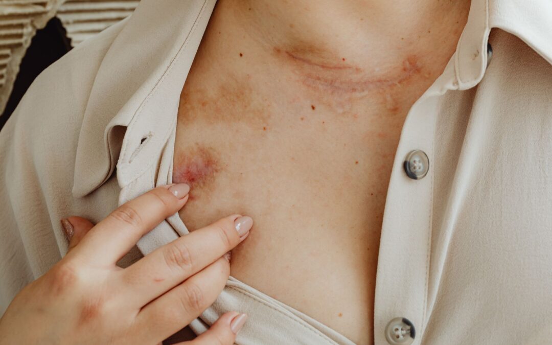 Can I Sue for Stevens-Johnson Syndrome?